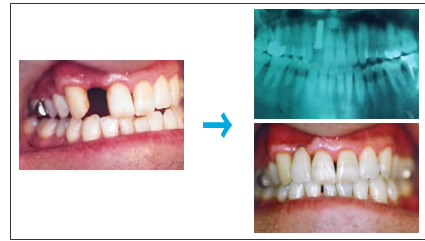 インプラント治療